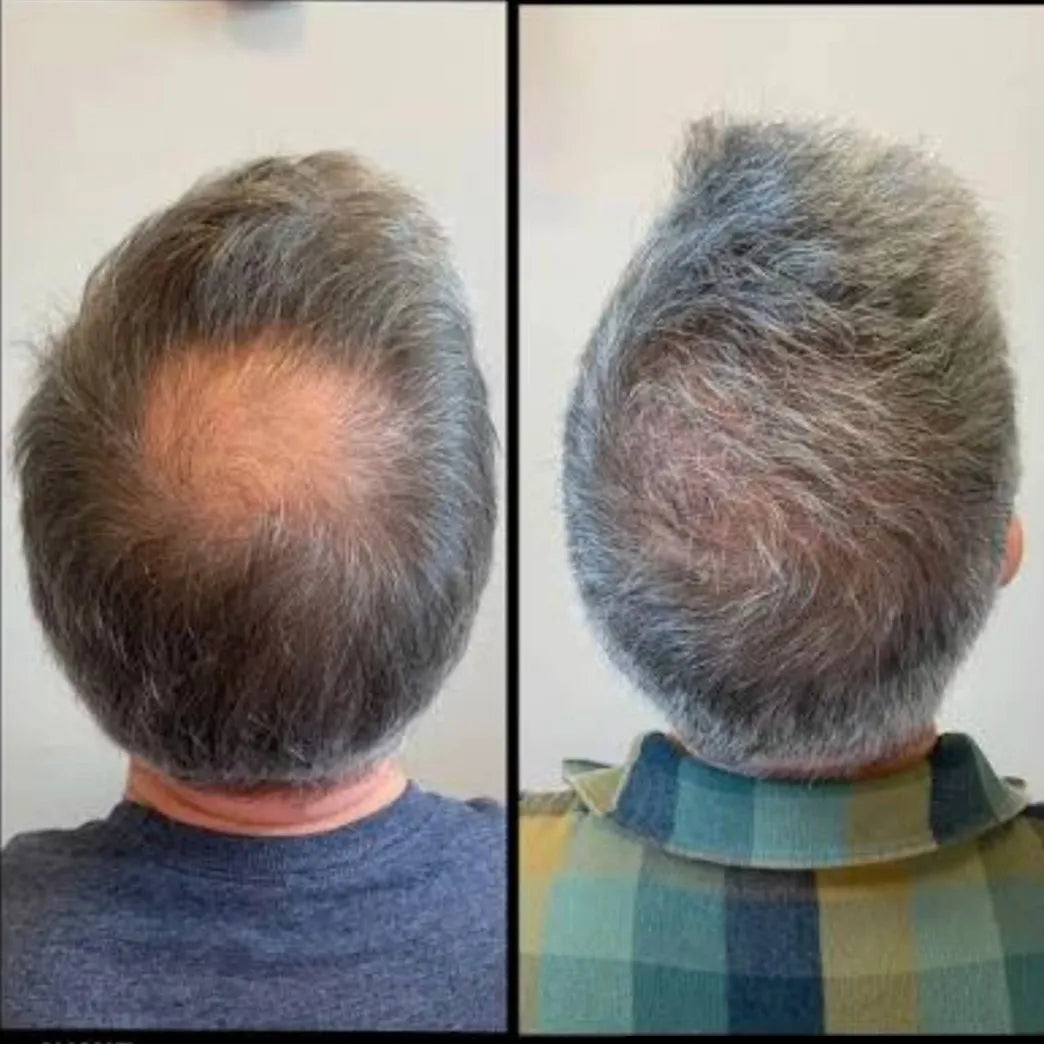 Loción Minoxildil al 5% para Caída de Pelo
