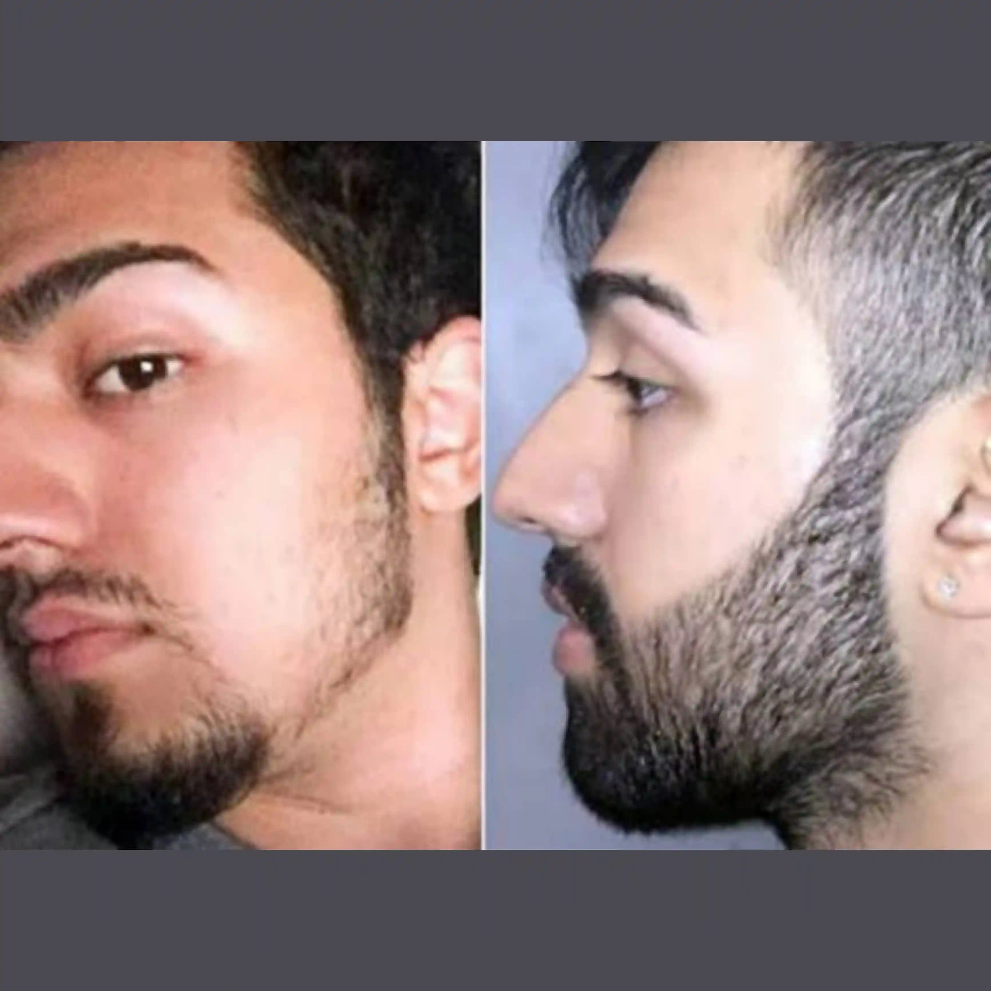 Loción Minoxildil al 5% para Caída de Pelo